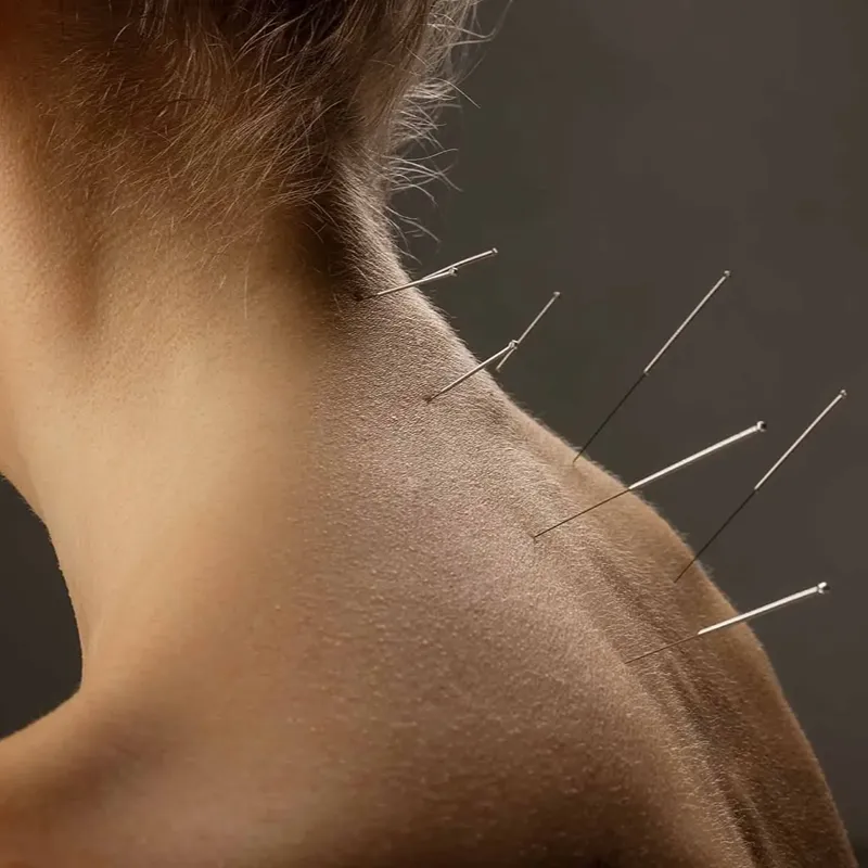 acupuncture-neck-pain-dry-needling-treatment-islington